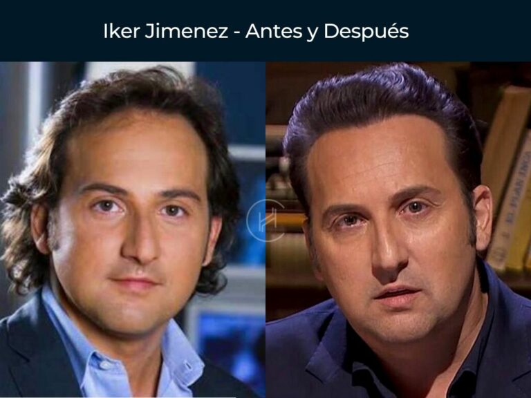 Famosos Con Injerto Pelo Fotos Del Antes Y Despu S