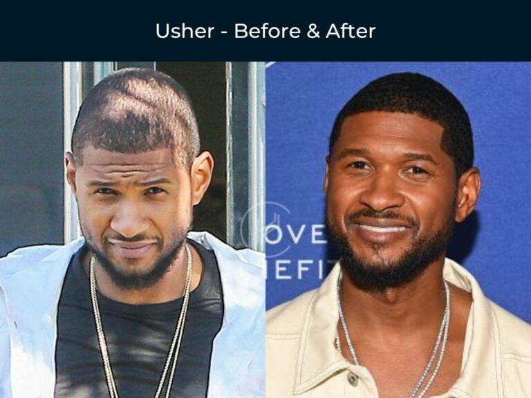 Black Celebrity Hair Transplants Before After Photos