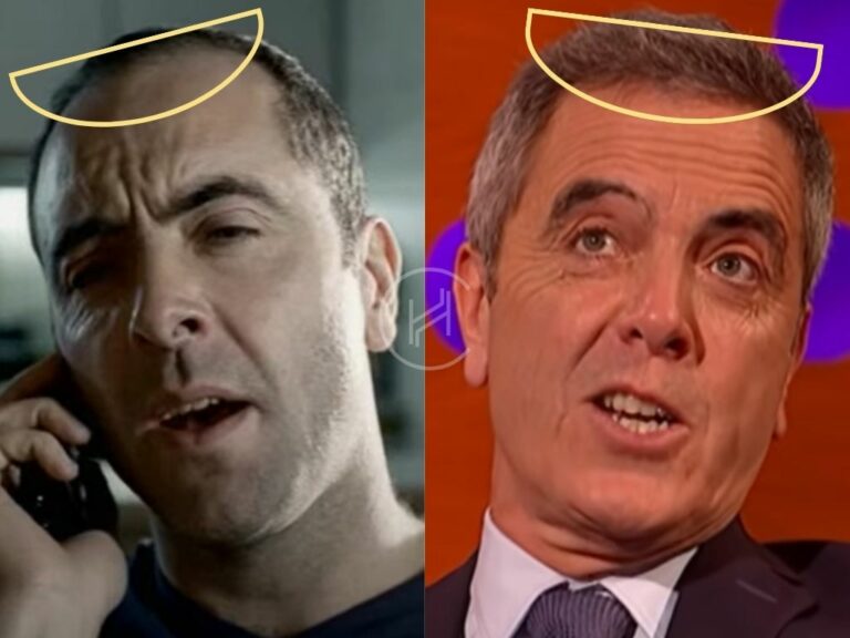 James Nesbitt Hair Transplant Hair Loss Technical Analysis