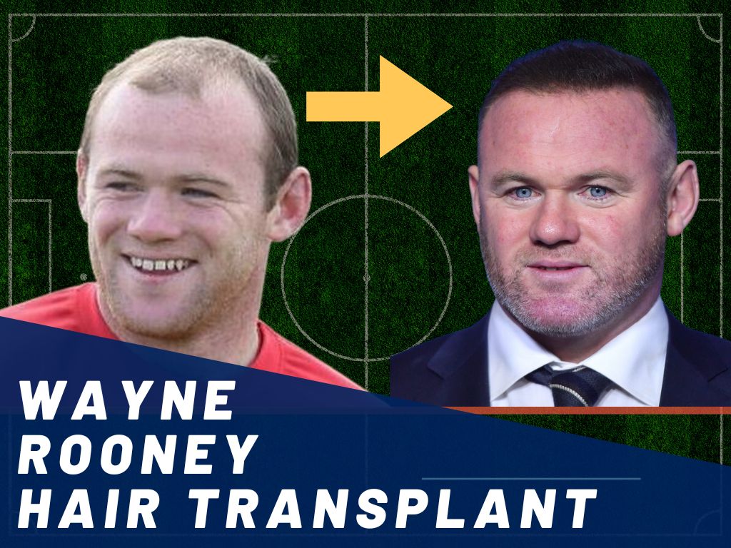 Details More Than 77 Wayne Rooney Hair Transplant Latest In Eteachers
