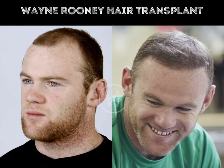 Wayne Rooney Hair Transplant Hair Loss Technical Analysis