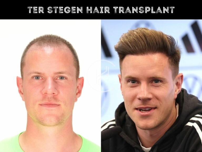 Ter Stegen Hair Transplant Hair Loss Technical Analysis