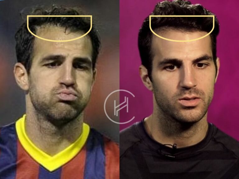 Cesc Fabregas Hair Transplant Hair Loss Technical Analysis