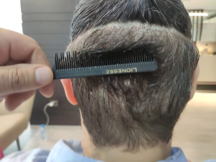 Trasplante capilar sin cortar el pelo - Precio en 2024 - Heva Clinic Turquía