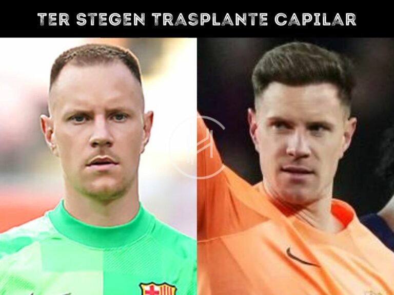 Ter Stegen Trasplante Capilar