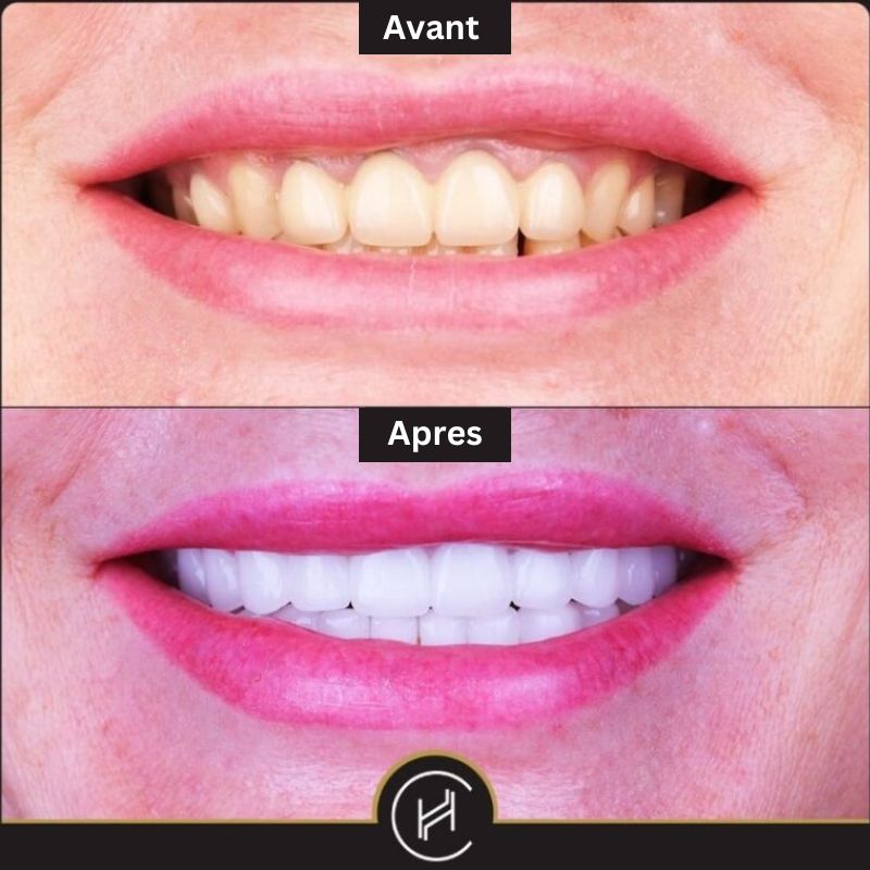 Facette dentaire : pose, prix, avant/après, durée de vie
