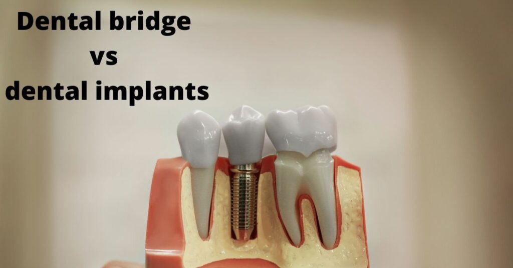 Dental Implants in Turkey | Procedure and Cost in Turkey | Heva Clinic