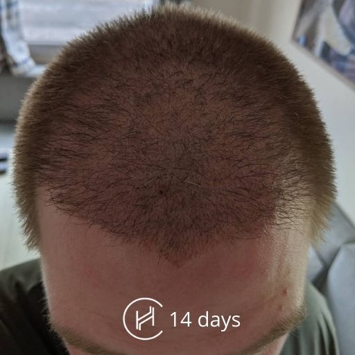 Hair Transplant Recovery Process With Photos From 0 to 7 days