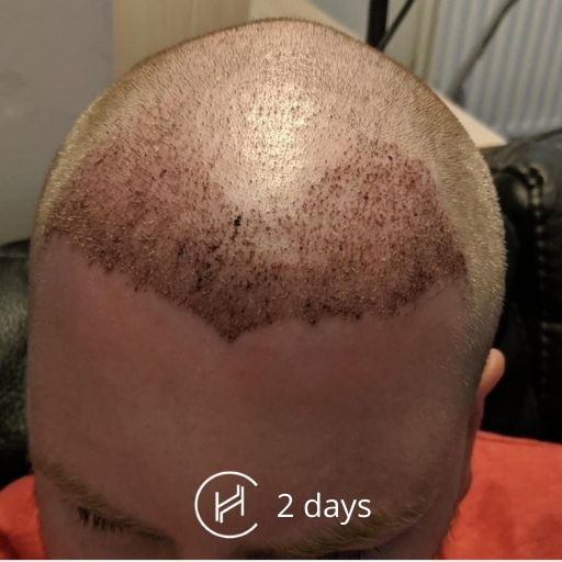 Post Op Recovery Photographs – 2 Weeks After FUE Hair Transplant