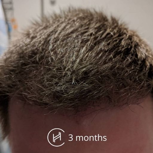 Hair Transplant Journey Hair Transplant After 3 Months  Results