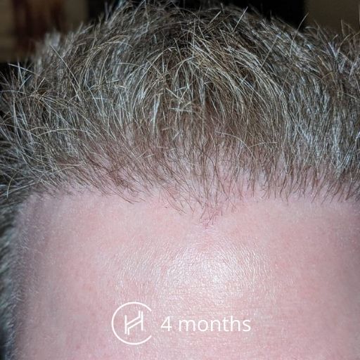 Faster Hair Growth after 5 Months with AFR Program