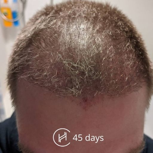 FUE Hair Transplant Timeline  Follow His Hair Restoration Journey