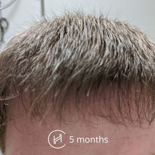 COZMODERM  Before and After one month Results ofAdvanced Hair Transplant  treatment with FUE technique performed at Cozmoderm Clinic by Dr Ankit  Agrawal No Pain No Stitches No Scars  Advanced Hair