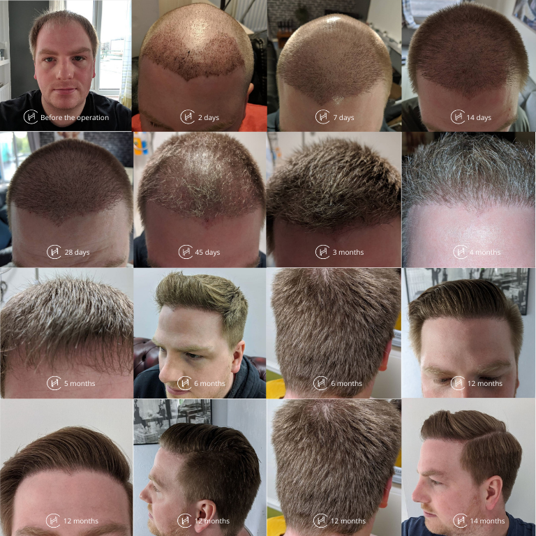 Is it possible to lose any hair grafts beyond 10 days after a transplant  operation  Quora