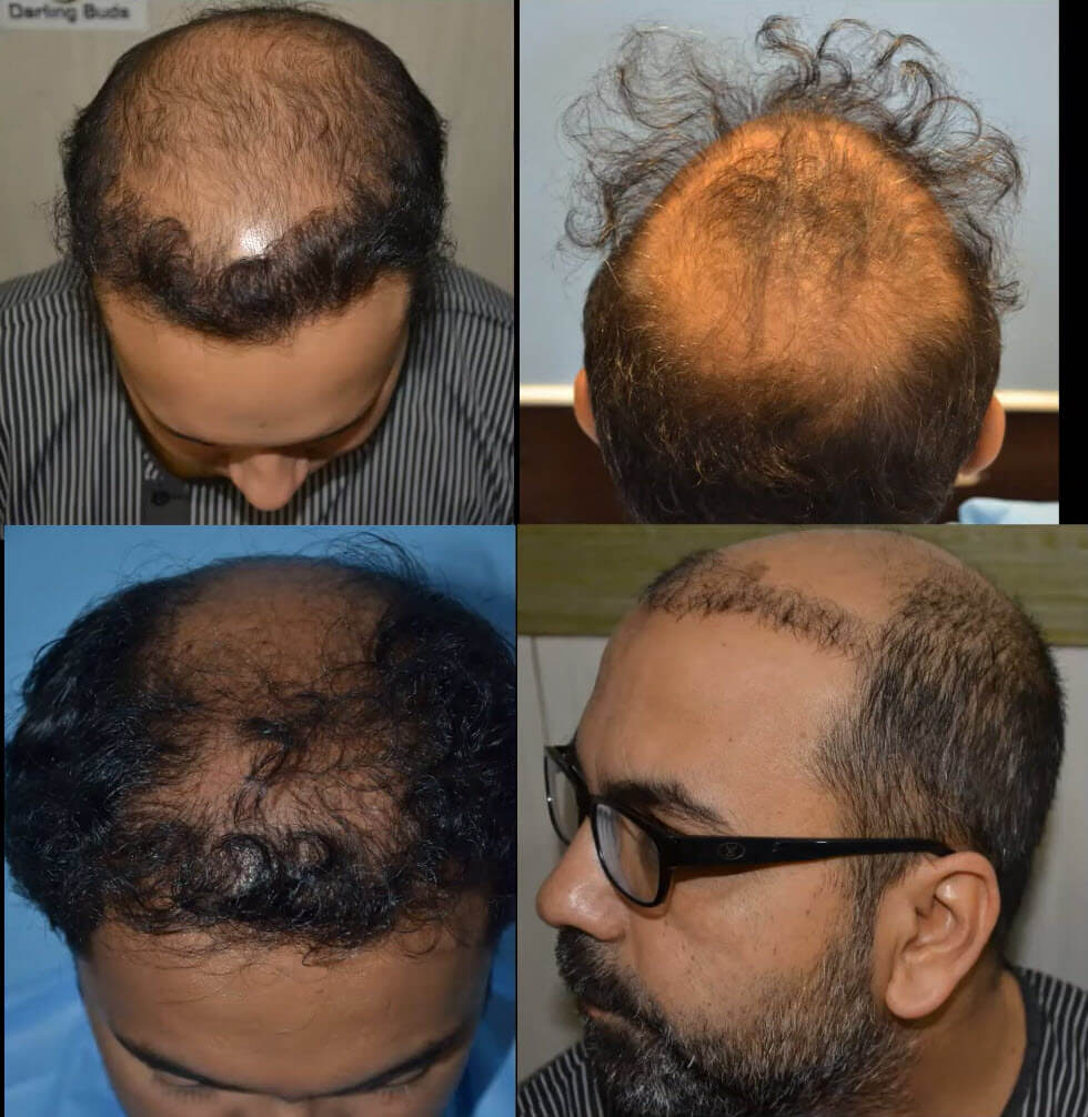 Growth of Hair After FUE  Maral Hair