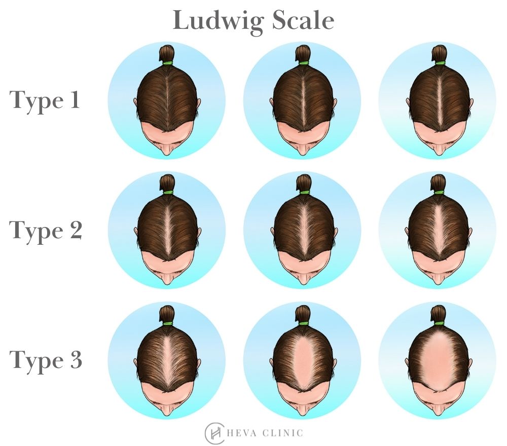 How can I treat female pattern baldness  according to three experts