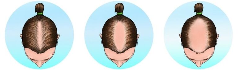 Ludwig Scale Female Baldness Pattern Heva Clinic