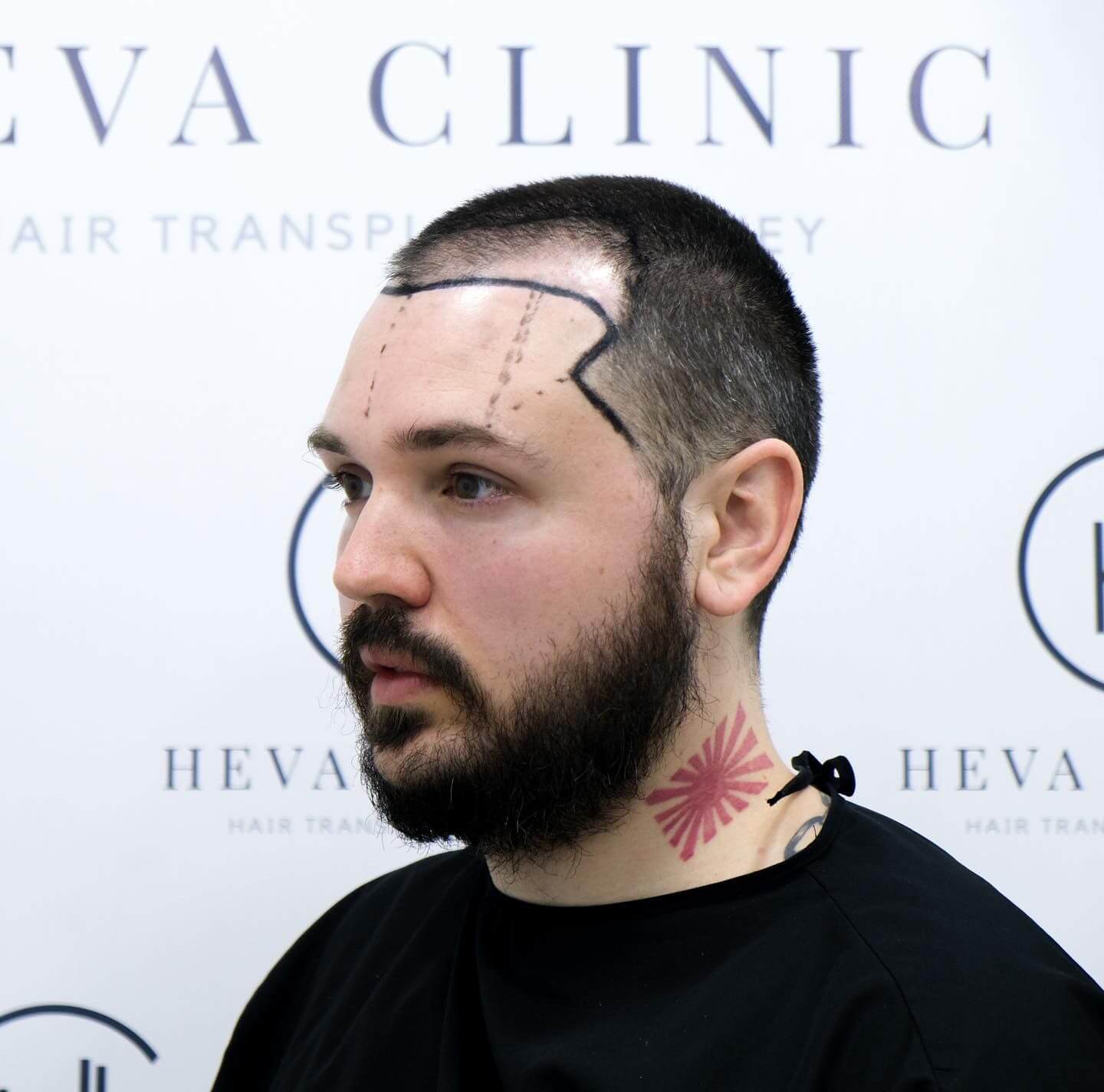 (Rogaine) Before and Hair Transplant - Use?