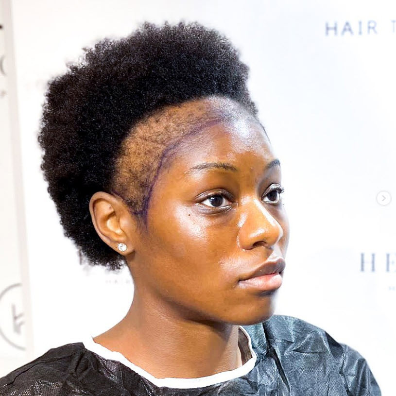 Afro female hair loss before hair transplant