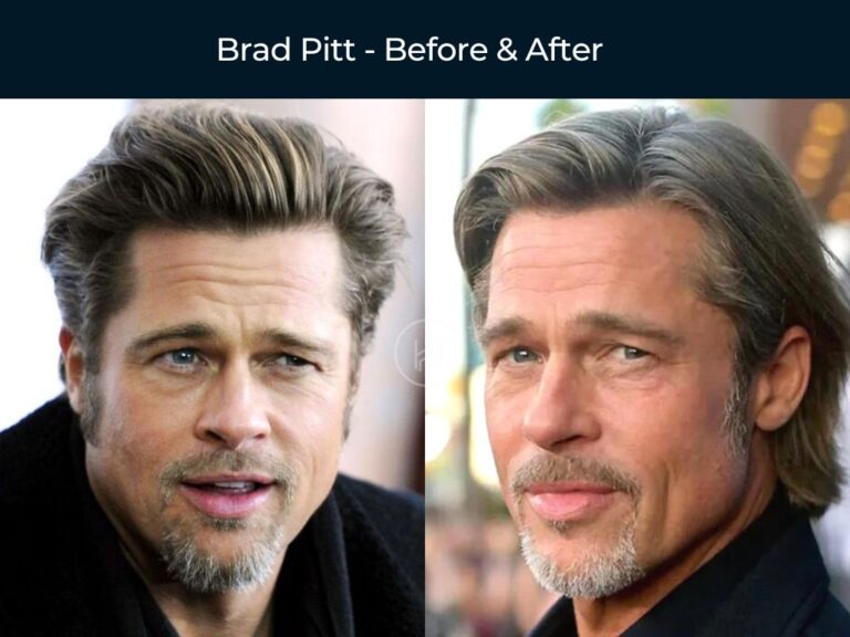 64 Celebrity Hair Transplants | Before & After Photos