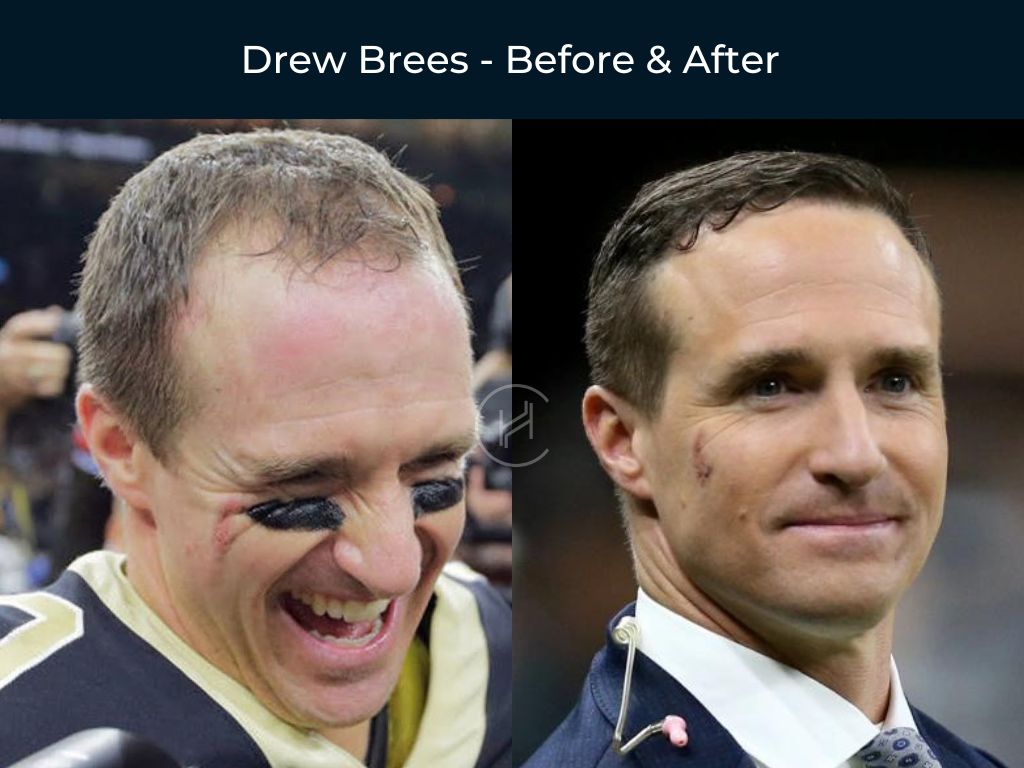 tom brady hair transplant before after