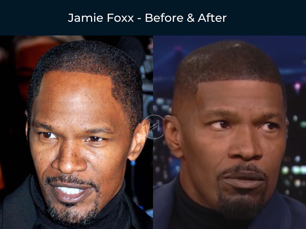 jamie foxx hair transplant before and after