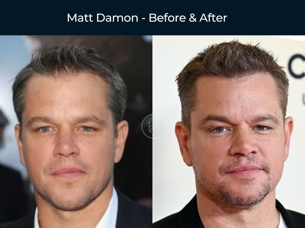 celebrities hair transplant