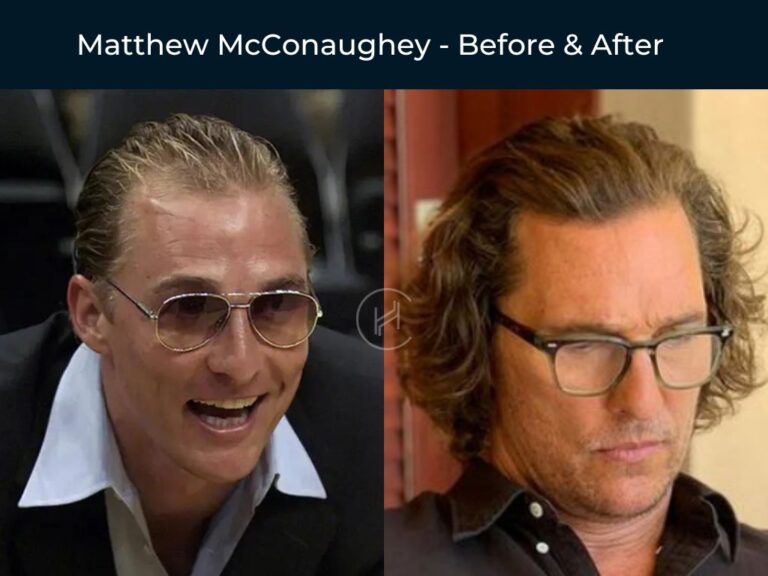 64 Celebrity Hair Transplants | Before & After Photos