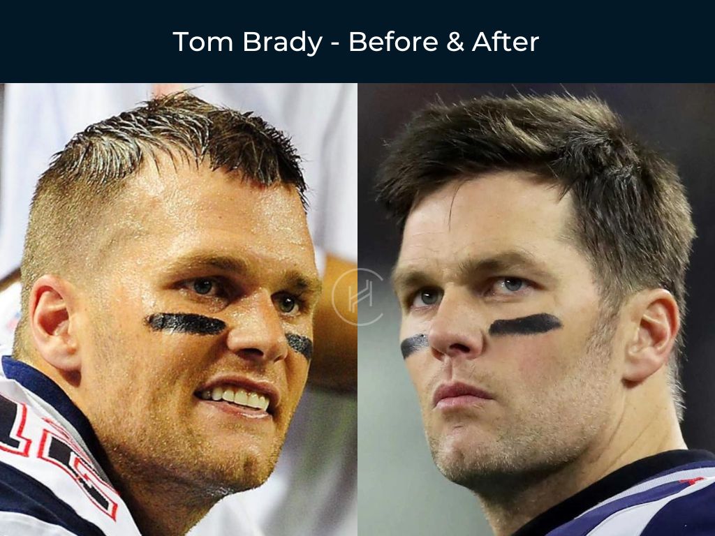 Super Bowl Star Tom Brady Hair Transplant Rumours Resurface
