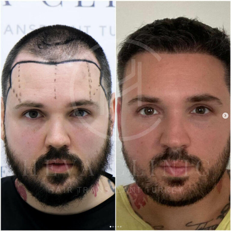 Hair Transplant Recovery Timeline 0 14 Months Photos 2245