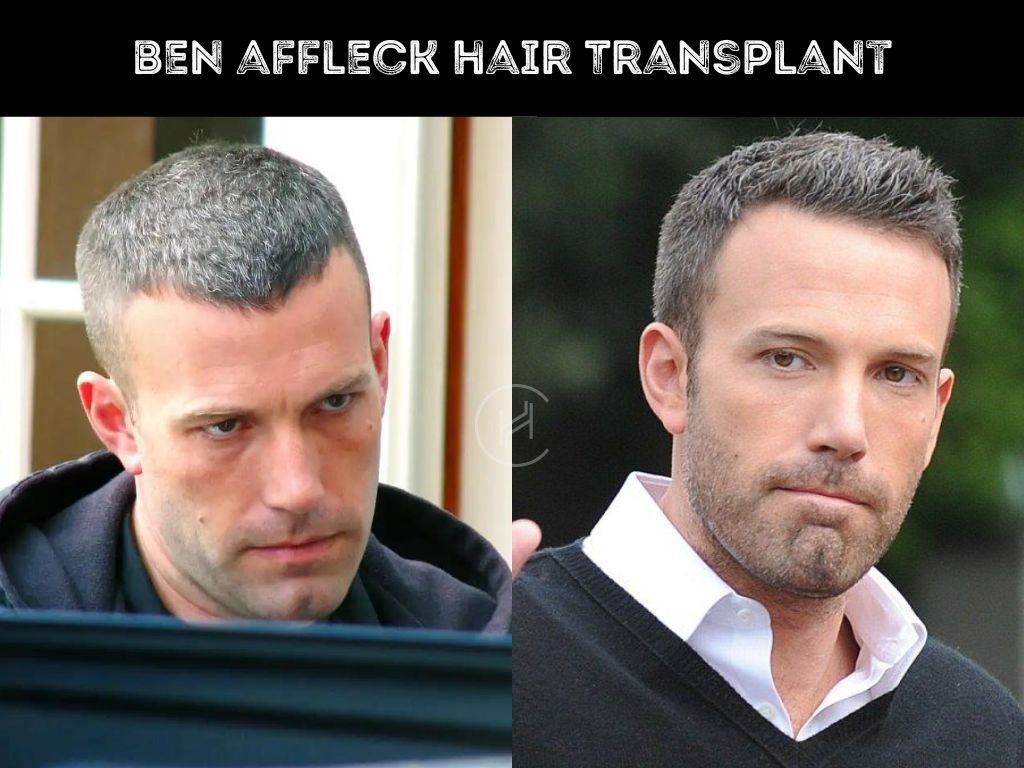 Hair Transplants for Receding Temples  Oak Brook IL