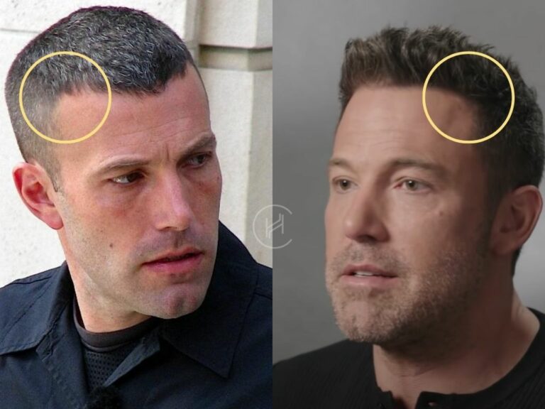 Ben Affleck Hair Transplant - Hair Loss & Technical Analysis