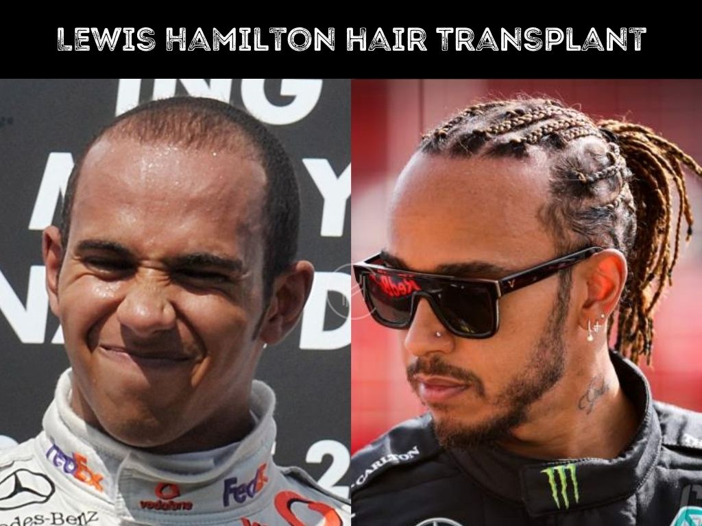 Lewis Hamilton denies rumours of a hair transplant despite new bushy locks  and says hotel shampoo caused barnet to look thin before  The Sun  The Sun