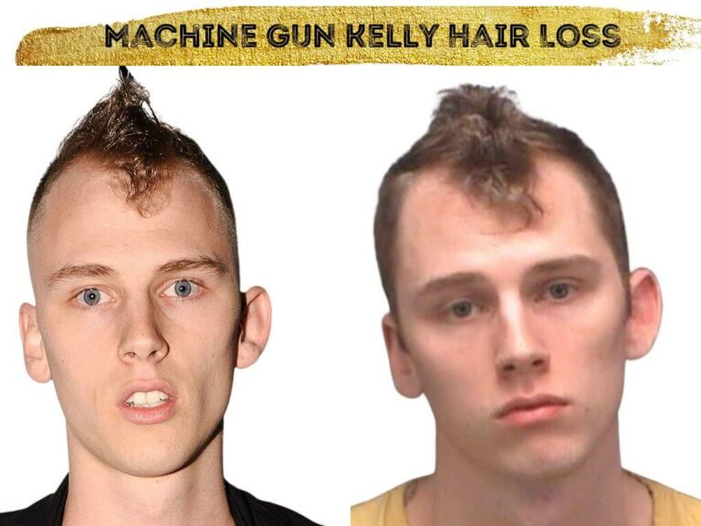 Machine Gun Kelly (MGK) Hair Transplant Hair Loss Stages