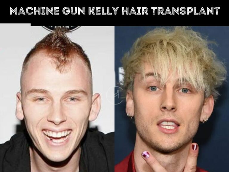 Machine Gun Kelly (MGK) Hair Transplant Hair Loss Stages