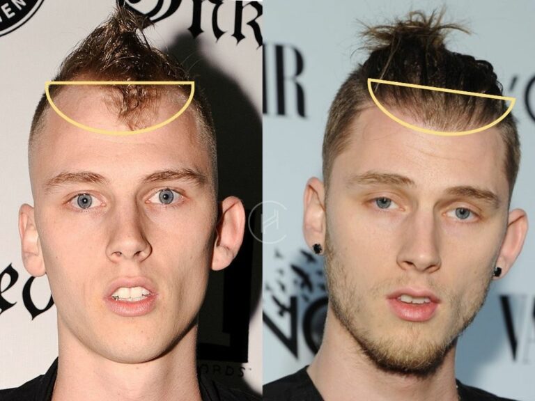 Machine Gun Kelly (MGK) Hair Transplant - Hair Loss Stages