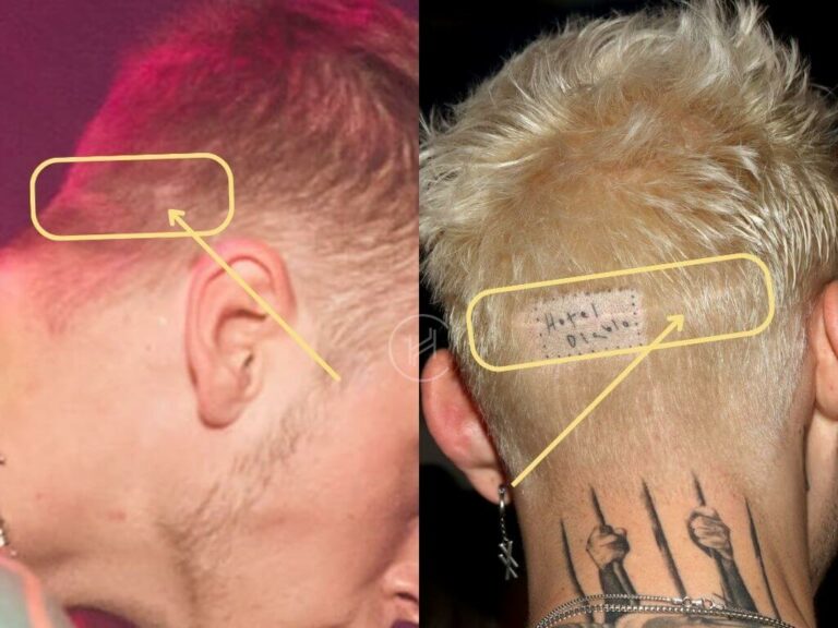 Machine Gun Kelly (MGK) Hair Transplant Hair Loss Stages