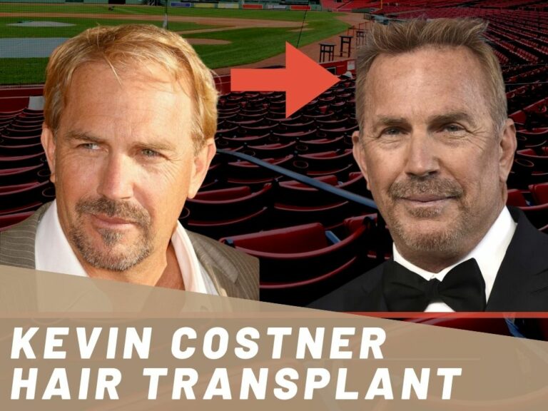 Kevin Costner Hair Transplant - Hair Loss & Technical Analysis