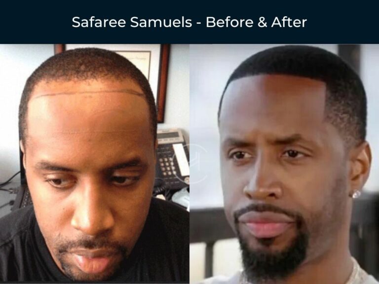 21 Black Celebrity Hair Transplants   Before & After Photos