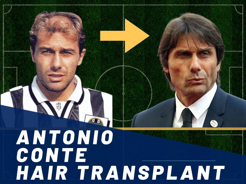 Antonio Conte Hair Transplant - Hair Loss & Technical Analysis