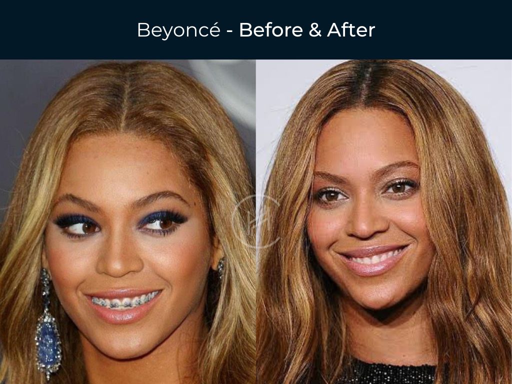 Before and after celebs with veneers