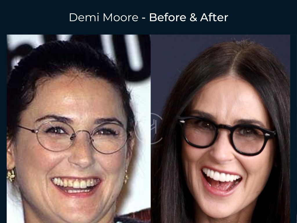 21 Celebrity Dental Implants And Veneers: Before And After - SHEfinds
