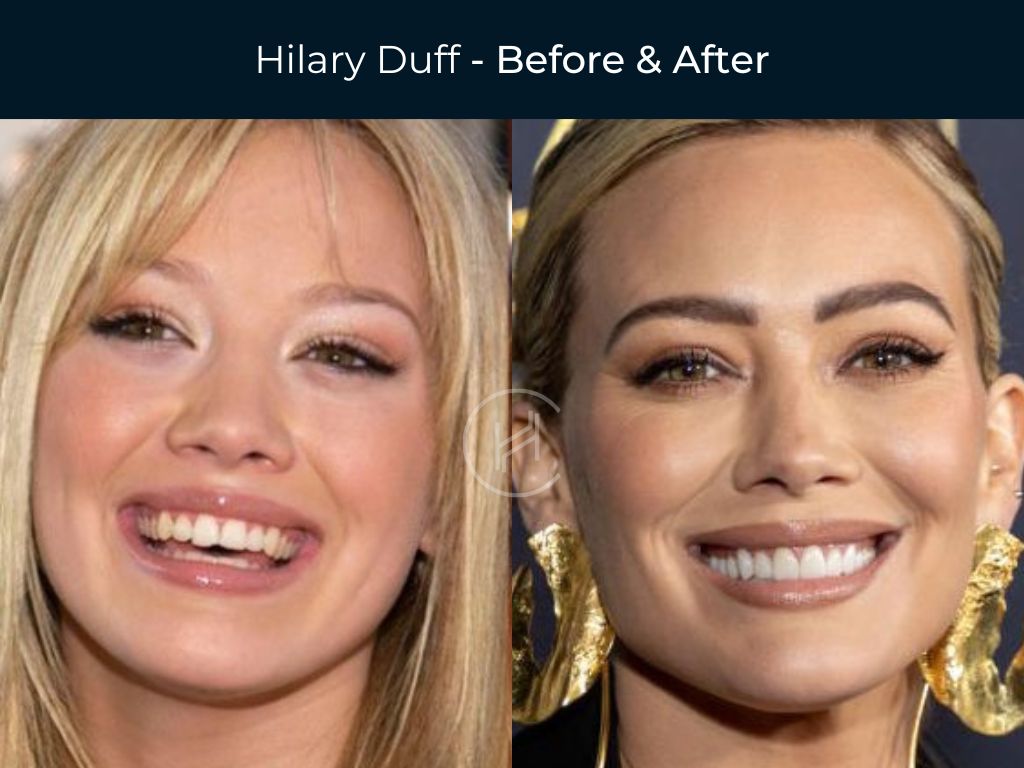 black celebrities with bad teeth before and after