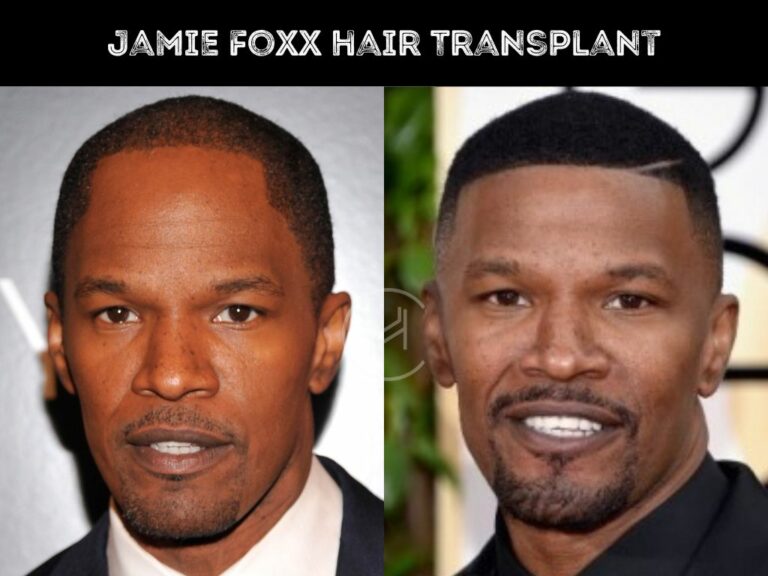 Jamie Foxx Hair Transplant Hair Loss Technical Analysis