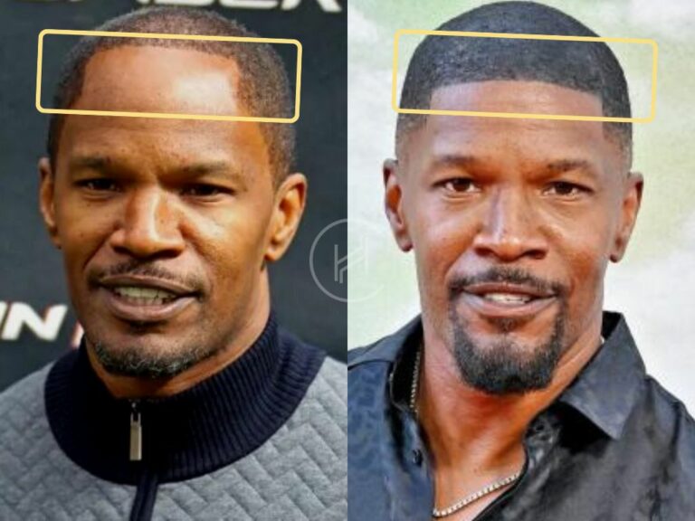 Jamie Foxx Hair Transplant Hair Loss Technical Analysis