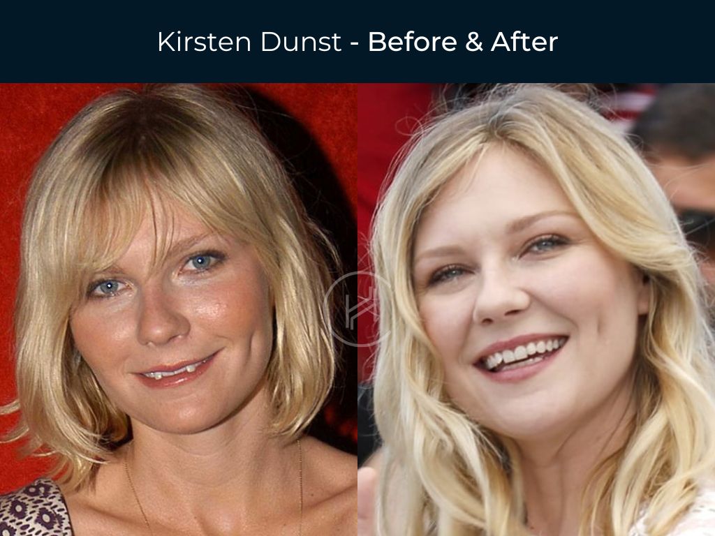Celebrity Dental Implants and Veneers Before and After Luv68