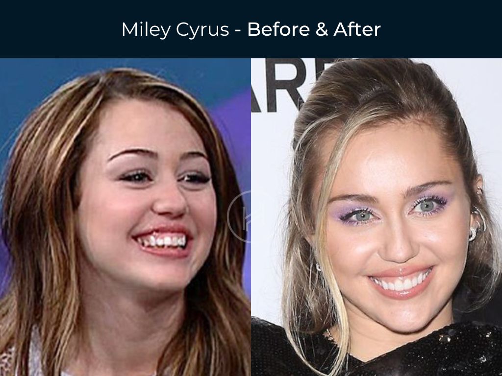 21 Celebrity Dental Implants And Veneers: Before And After - SHEfinds