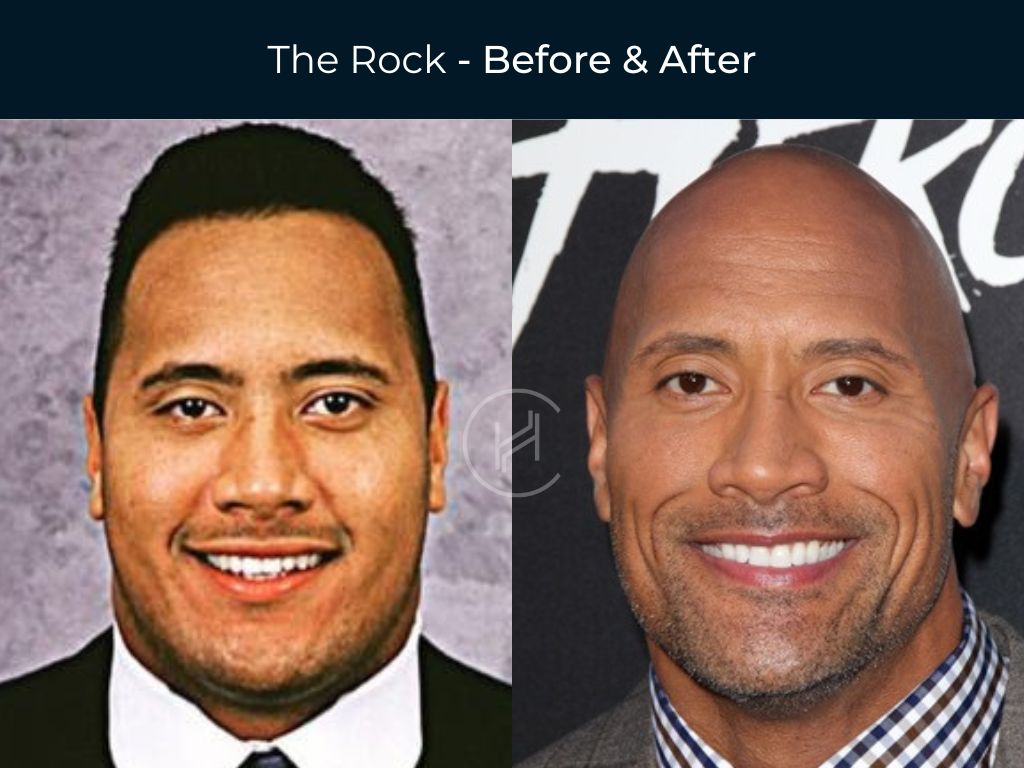 Before and after celebs with veneers