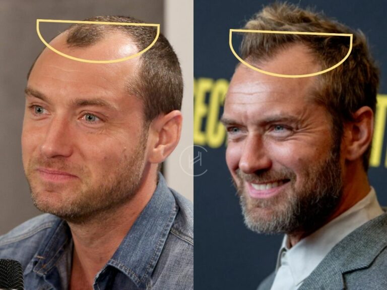Jude Law Hair Transplant Hair Loss And Technical Analysis 