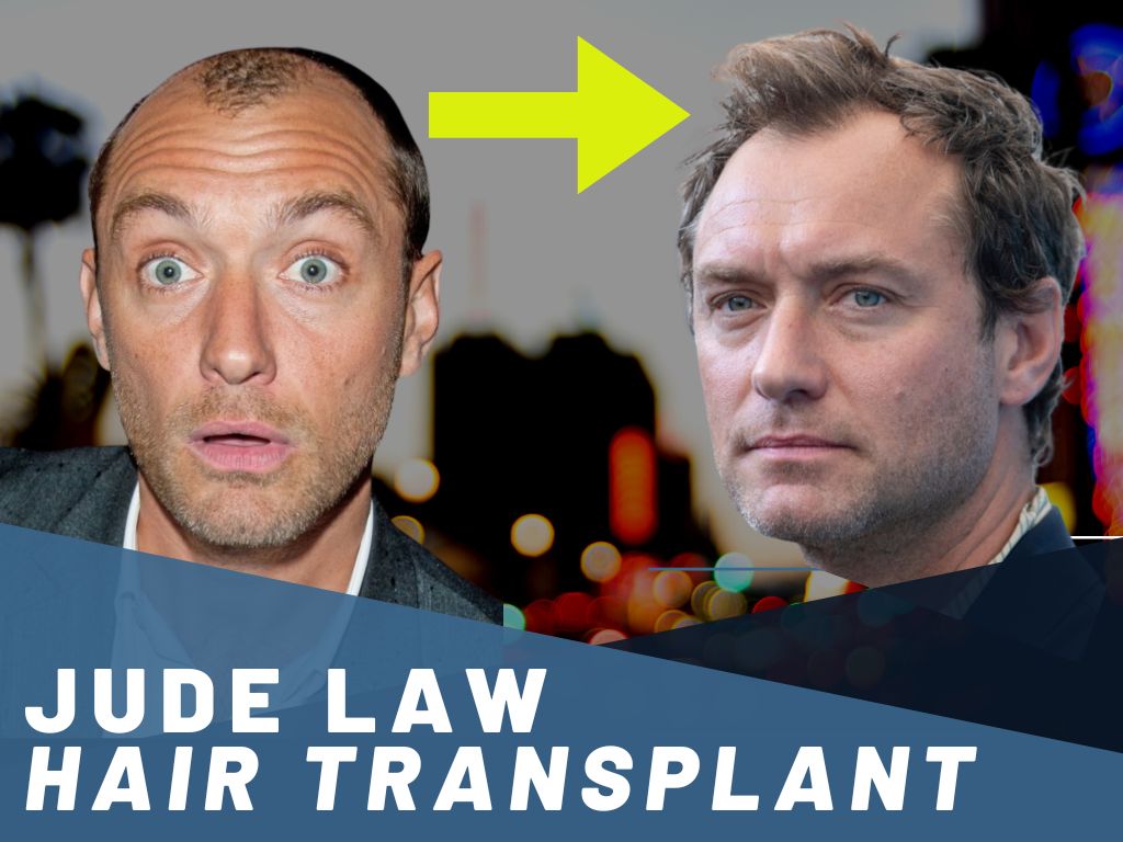 Jude Law Hair Transplant - Hair Byte
